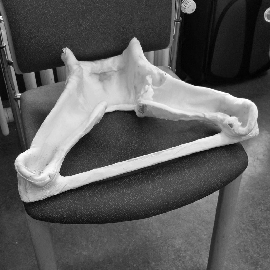 Gips Hüftdysplasie Luxation
