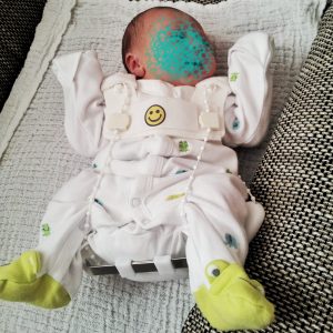 Hüfte Baby Hüftdysplasie Hüftscreening
