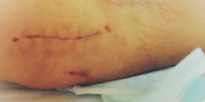 (13) Diagnose angehende Reluxation – Pfannendachplastik